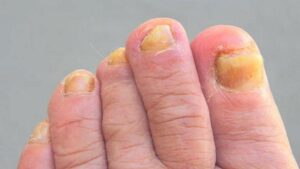choroby paznokci u stóp - grzybica paznokci