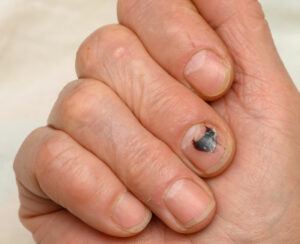 choroby paznokci u stóp - krwiak pod paznokciem