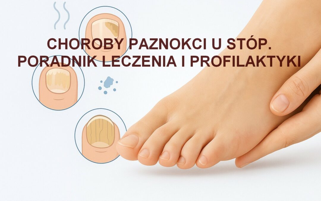 Choroby paznokci u stóp – poradnik leczenia i profilaktyki