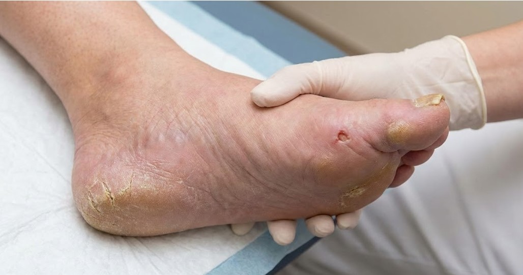 Stopa cukrzycowa w gabinecie podologicznym Część I Stopa cukrzycowa 2